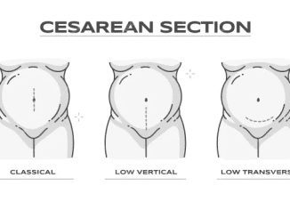 cesarean-section