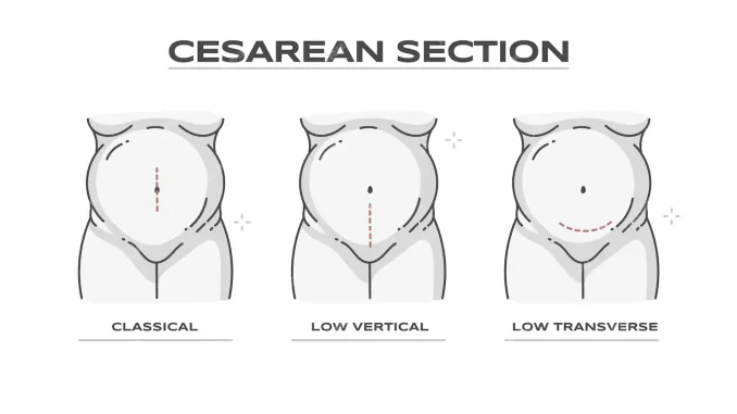 cesarean-section