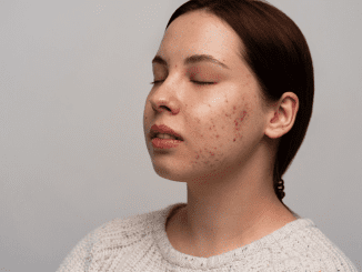 Nine Skin Care Routines That Might Prevent Pimples on Your Face