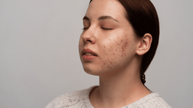 Nine Skin Care Routines That Might Prevent Pimples on Your Face